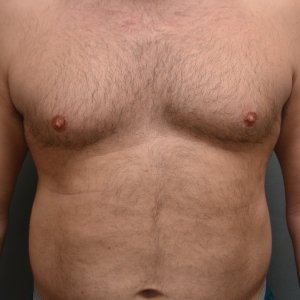 manhattan gynecomastia surgery before 3